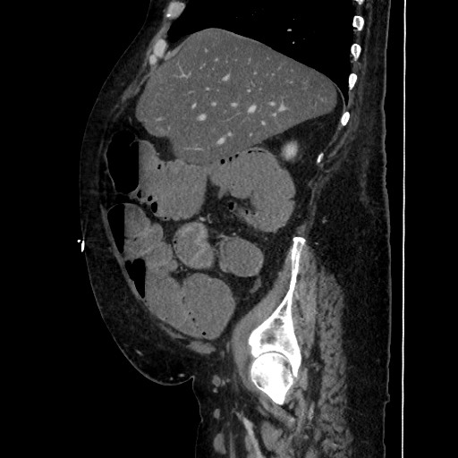 Obstructive colonic diverticular stricture (Radiopaedia 81085-94675 C 75).jpg