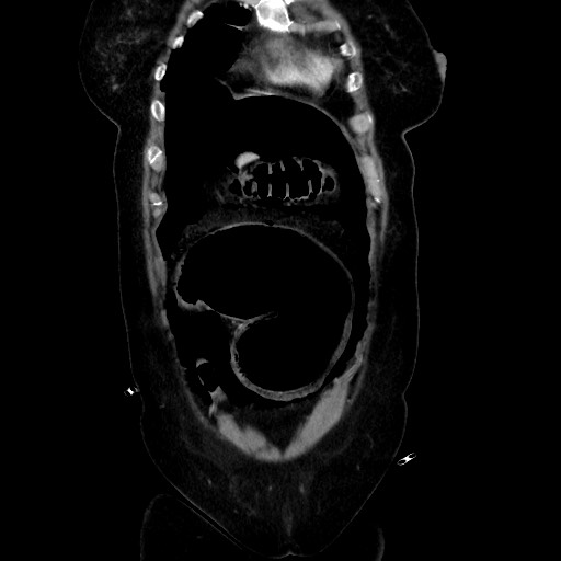 Obstructive distal colonic adenocarcinoma causing cecal perforation (Radiopaedia 86830-102989 C 55).jpg