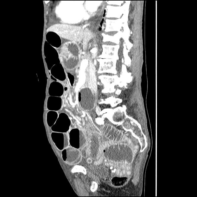 Obturator hernia causing small bowel obstruction (Radiopaedia 65522-74612 C 55).jpg