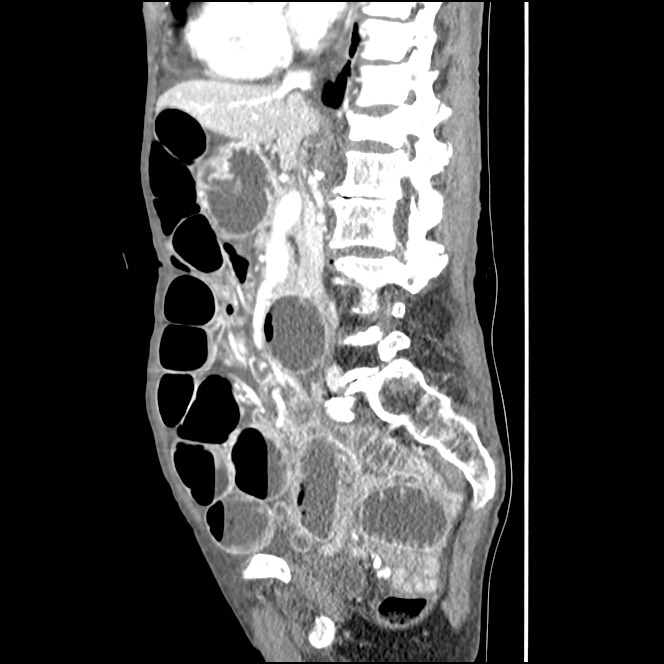 Obturator hernia causing small bowel obstruction (Radiopaedia 65522-74612 C 56).jpg