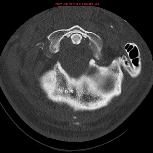 File:Occipital condyle fracture (Radiopaedia 18366-18208 Axial bone window 14).jpg