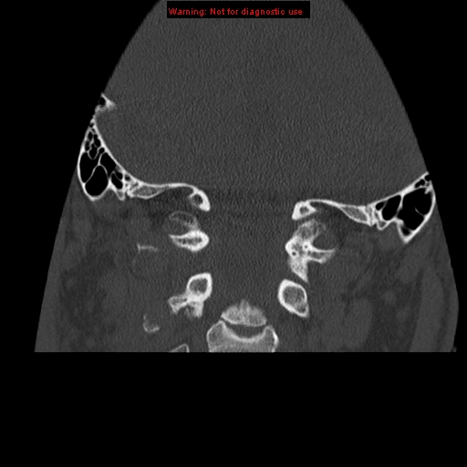 File:Occipital condyle fracture (Radiopaedia 18366-18208 Coronal bone window 15).jpg