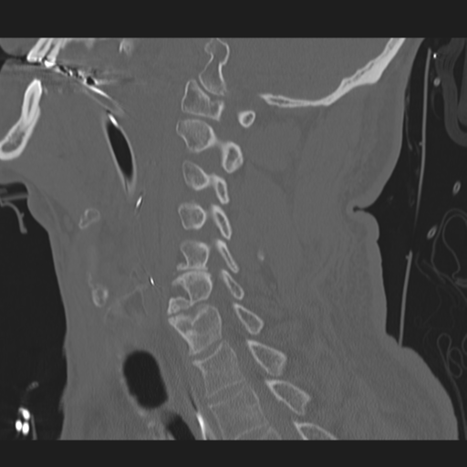 File:Occipital condyle fracture (Radiopaedia 33467-34517 Sagittal bone window 44).png