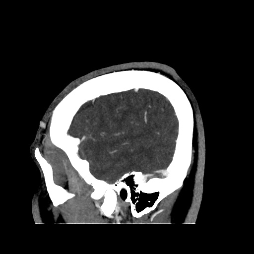 Occipital extradural hematoma simulating venous sinus thrombosis (Radiopaedia 46514-50964 D 12).jpg