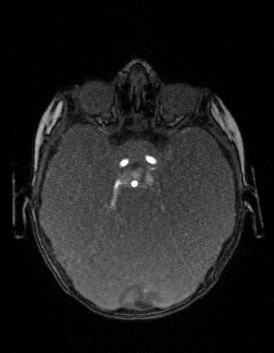Occipital horn syndrome (Radiopaedia 14255-14129 MRA 53).jpg