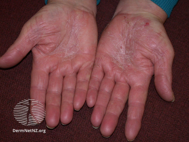 File:Psoriasis (DermNet NZ scaly-acquired-kd3).jpg