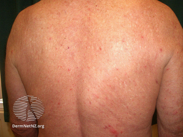 Rosacea (DermNet NZ acne-red-face-3601).jpg