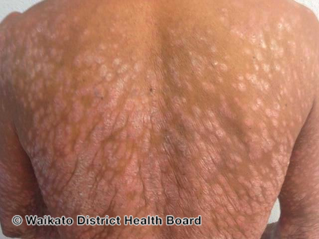 File:Severe psoriasis affecting back (DermNet NZ psoriasis-severe-back).jpg
