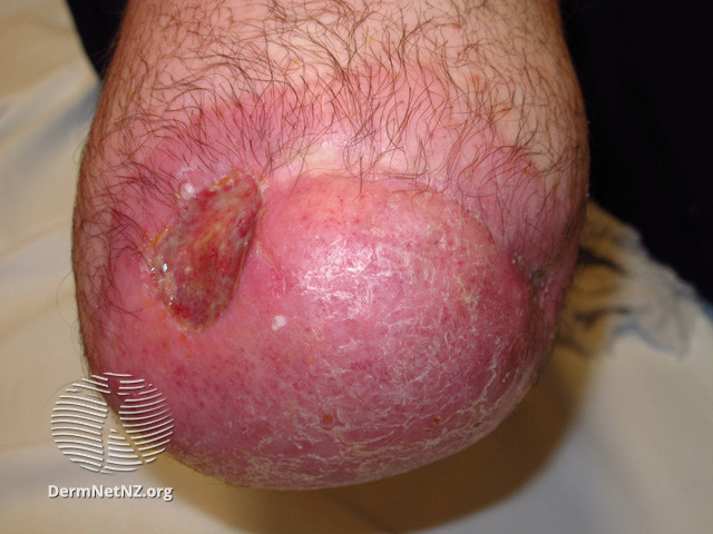 File:Ulceration and dermatitis (DermNet NZ reactions-amputation-stump-02).jpg