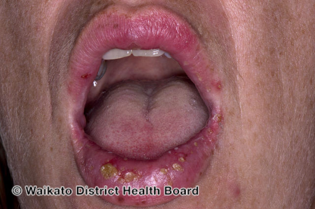 (DermNet NZ herpes-simplex-labialis-45).jpg