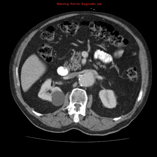 Abdominal aortic aneurysm (Radiopaedia 10122-10660 Axial C+ portal venous phase 27).jpg