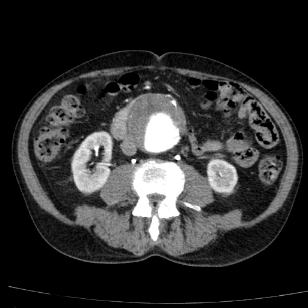 Abdominal aortic aneurysm (Radiopaedia 29248-29660 Axial C+ arterial phase 45).jpg