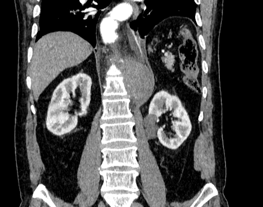 Abdominal aortic aneurysm (Radiopaedia 67117-76452 Coronal C+ arterial phase 68).jpg