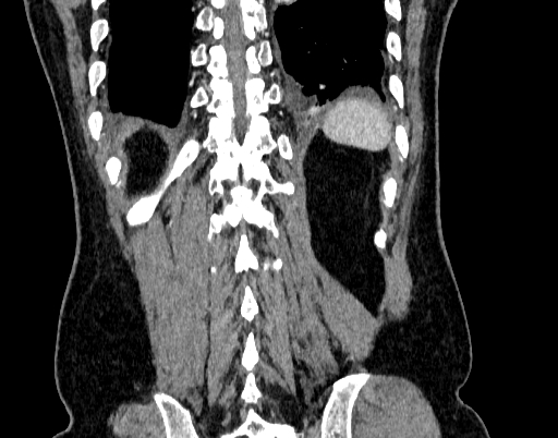 File:Abdominal aortic aneurysm (Radiopaedia 67117-76452 Coronal C+ arterial phase 96).jpg