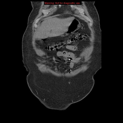 Abdominal aortic aneurysm (Radiopaedia 8190-9038 Coronal C+ arterial phase 18).jpg