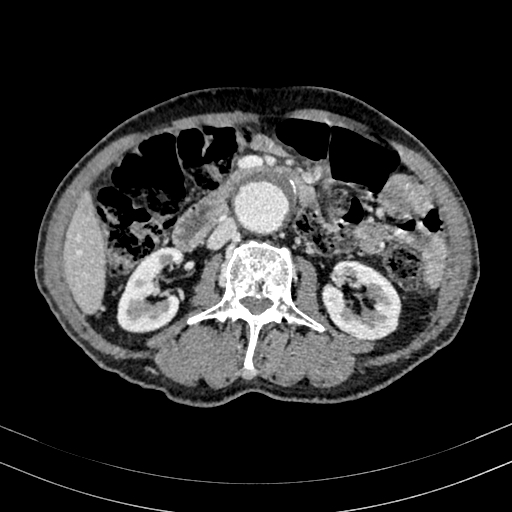 Abdominal aortic aneurysm (Radiopaedia 83581-98689 Axial C+ portal venous phase 53).jpg