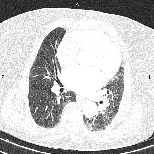 Abdominal aortic aneurysm (Radiopaedia 85063-100606 Axial lung window 37).jpg