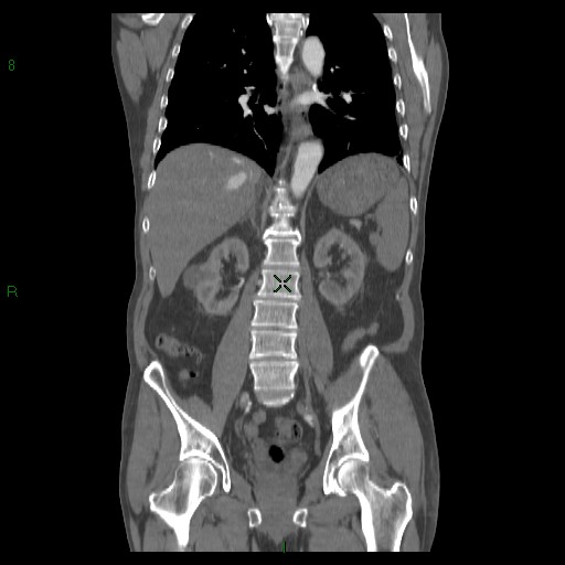 File:Abdominal aortic aneurysm rupture with aortocaval fistula (Radiopaedia 14897-14841 Coronal C+ arterial phase 29).jpg