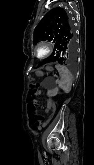 Abdominal aortic aneurysm with thrombus fissuration (Radiopaedia 73192-83919 Sagittal C+ arterial phase 26).jpg