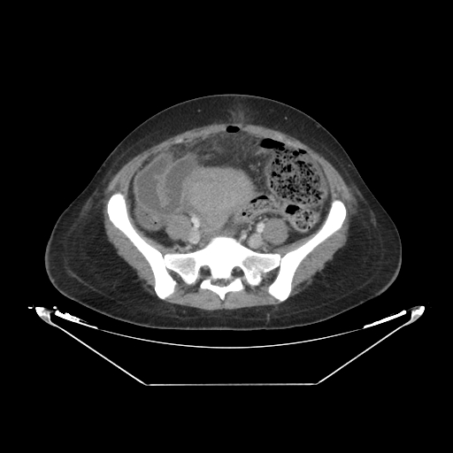 Abdominal gossypiboma- surgical towel (Radiopaedia 57288-64226 Axial C+ portal venous phase 54).jpg