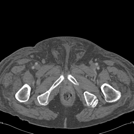 File:Abdominal hematoma (Radiopaedia 33614-34715 Axial C+ portal venous phase 141).png