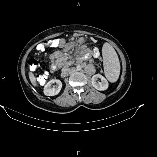 Abdominal lymphoma with sandwich sign (Radiopaedia 84378-99704 Axial C+ portal venous phase 27).jpg