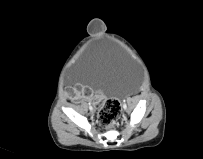 Abdominal premesenteric cystic lymphangioma (Radiopaedia 82995-97350 Axial C+ portal venous phase 55).jpg