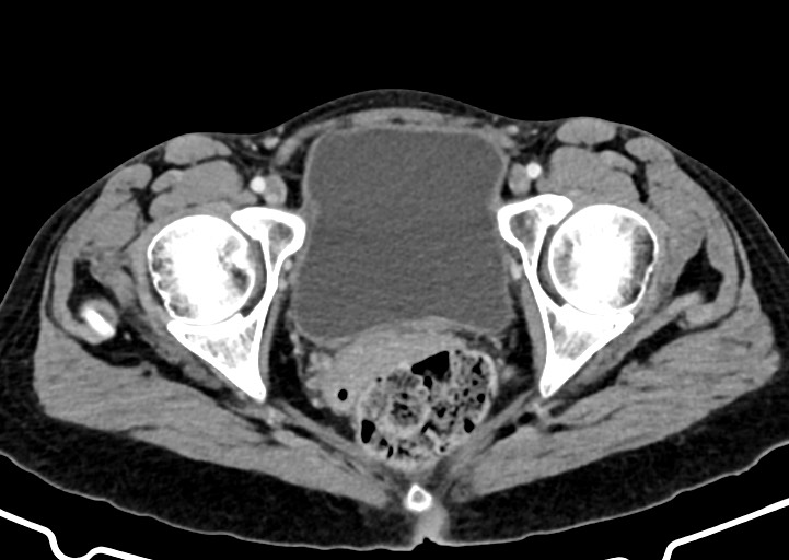 Abdominal wall and retroperitoneal tuberculosis (Radiopaedia 88137-104729 Axial C+ portal venous phase 180).jpg