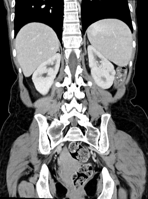 Abdominal wall and retroperitoneal tuberculosis (Radiopaedia 88137-104729 Coronal C+ portal venous phase 72).jpg