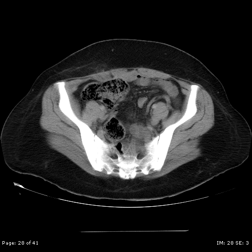 File:Abdominal wall endometriosis (Radiopaedia 25723-25885 Axial C+ portal venous phase 28).jpg