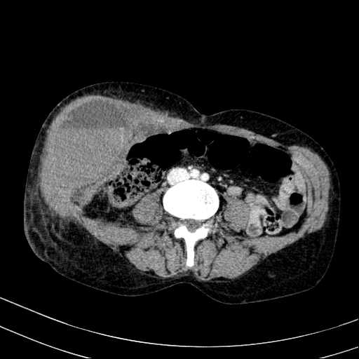 Abdominal wall hematoma with active bleeding (Radiopaedia 83915-99117 Axial C+ portal venous phase 64).jpg