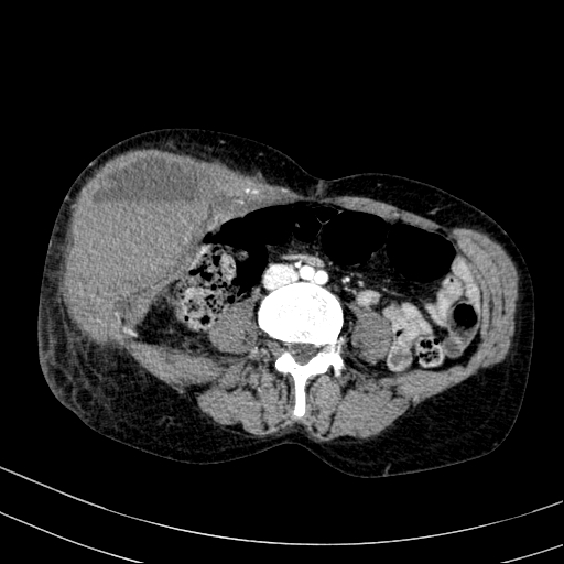 File:Abdominal wall hematoma with active bleeding (Radiopaedia 83915-99117 Axial renal cortical phase 63).jpg