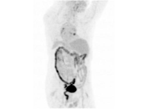File:Abdominal wall metastasis from colorectal carcinoma (Radiopaedia 31016-31719 Rotational MIP 19).jpg