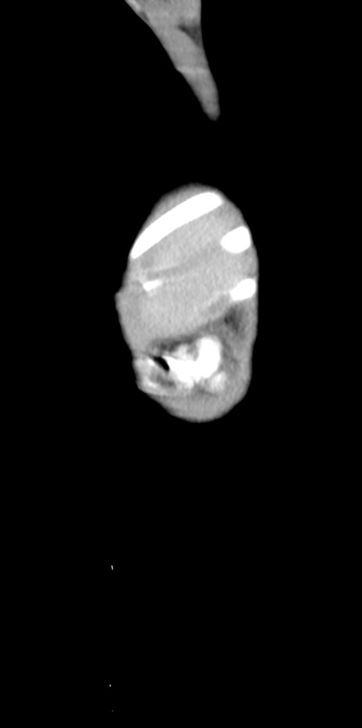 Abdominopelvic rhabdomyosarcoma (Radiopaedia 78356-90984 Sagittal C+ portal venous phase 8).jpg