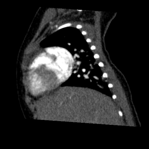 Aberrant left pulmonary artery (pulmonary sling) (Radiopaedia 42323-45435 Sagittal C+ arterial phase 15).jpg