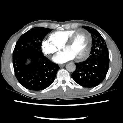 Accessory left horizontal fissure with lingular pneumonia (Radiopaedia 53763-59843 Axial C+ CTPA 64).jpg