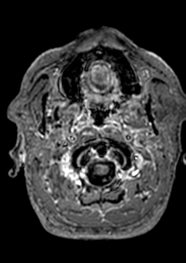 File:Accessory middle cerebral artery (Radiopaedia 73114-83828 Axial T1 C+ 202).jpg
