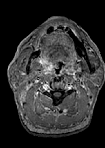 File:Accessory middle cerebral artery (Radiopaedia 73114-83828 Axial T1 C+ 271).jpg