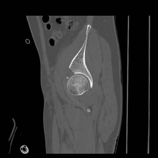 Acetabular and ilial fractures (Radiopaedia 59084-66378 Sagittal bone window 24).jpg