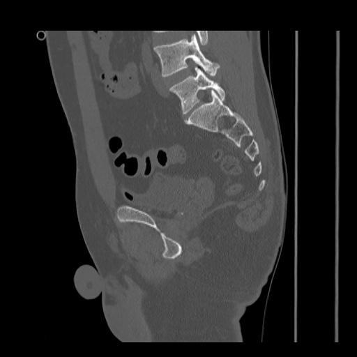 Acetabular and ilial fractures (Radiopaedia 59084-66378 Sagittal bone window 58).jpg