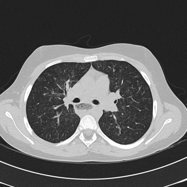 Achalasia (Radiopaedia 14946-14878 Axial lung window 29).jpg