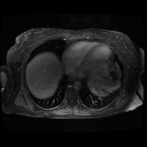Acinar cell carcinoma of the pancreas (Radiopaedia 75442-86668 Axial T1 C+ fat sat 136).jpg