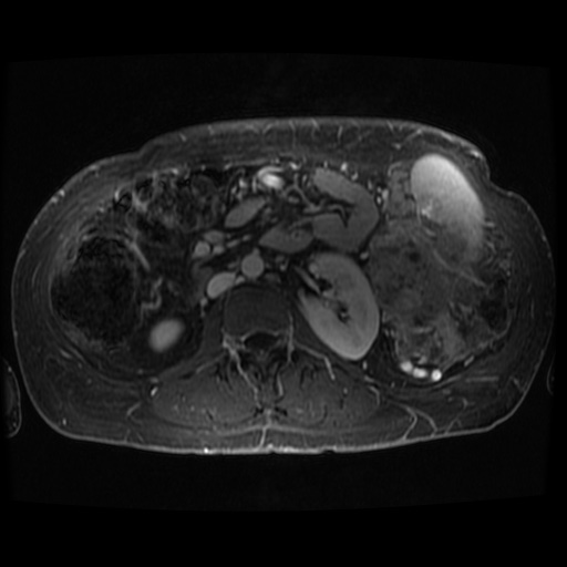 Acinar cell carcinoma of the pancreas (Radiopaedia 75442-86668 D 21).jpg