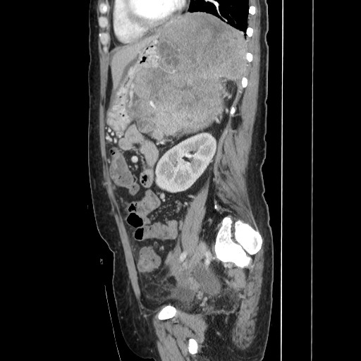 Acinar cell carcinoma of the pancreas (Radiopaedia 75442-86669 Sagittal C+ portal venous phase 124).jpg