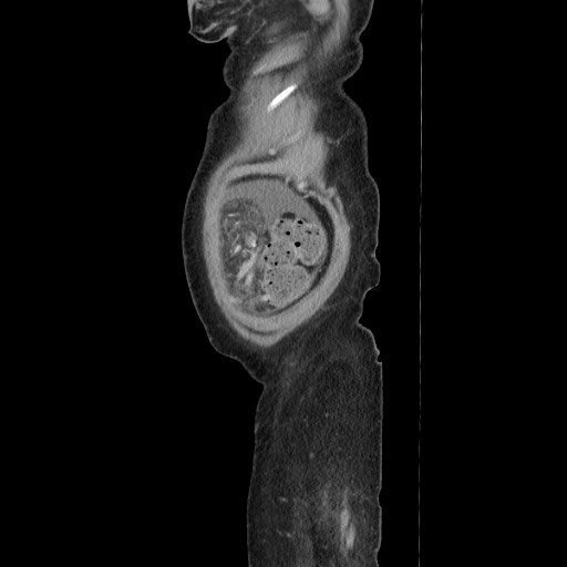 Acinar cell carcinoma of the pancreas (Radiopaedia 75442-86669 Sagittal C+ portal venous phase 180).jpg