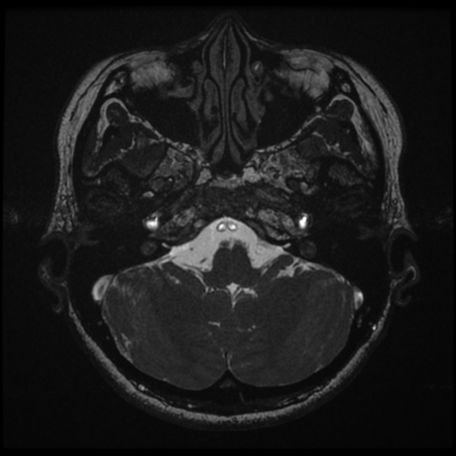 Acoustic neuroma (Radiopaedia 34049-35283 Axial 36).png