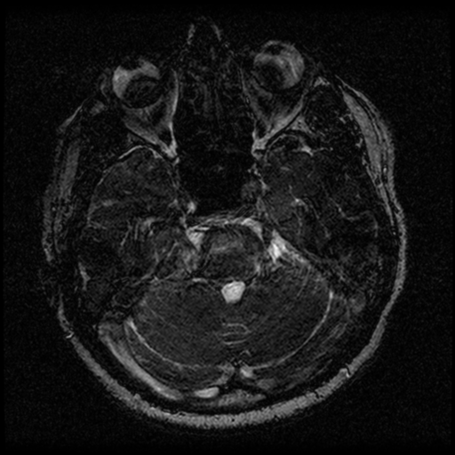 Acoustic schwannoma (Radiopaedia 33045-34060 Axial T2 48).png