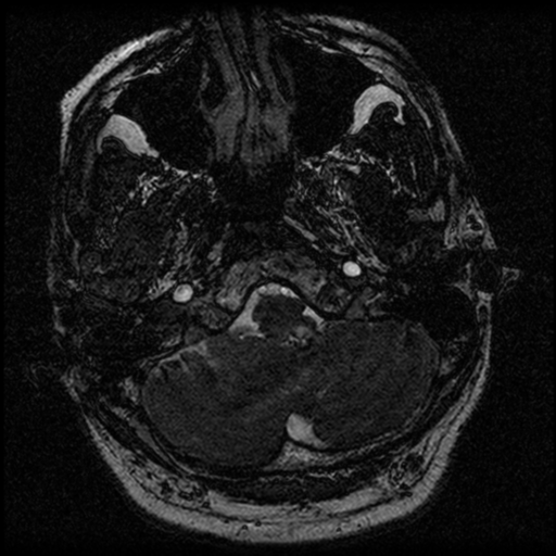 File:Acoustic schwannoma (Radiopaedia 39170-41387 Axial FIESTA 30).png