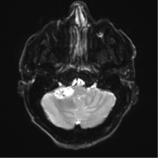File:Acoustic schwannoma (Radiopaedia 50846-56358 Axial DWI 5).png