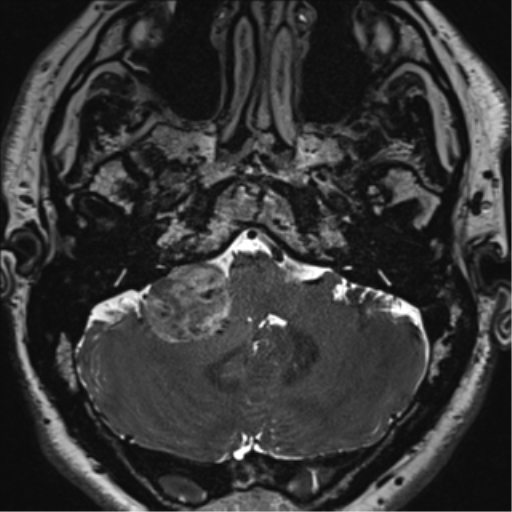 File:Acoustic schwannoma (Radiopaedia 50846-56358 Axial T2 14).png